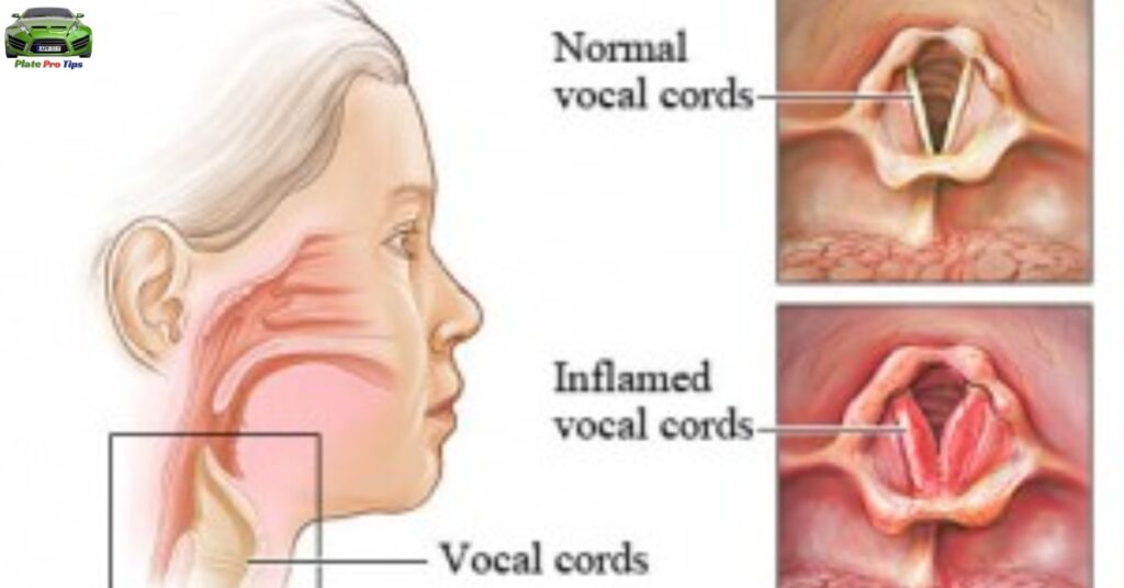 The Impact Of A Gravelly Voice In Various Conditions